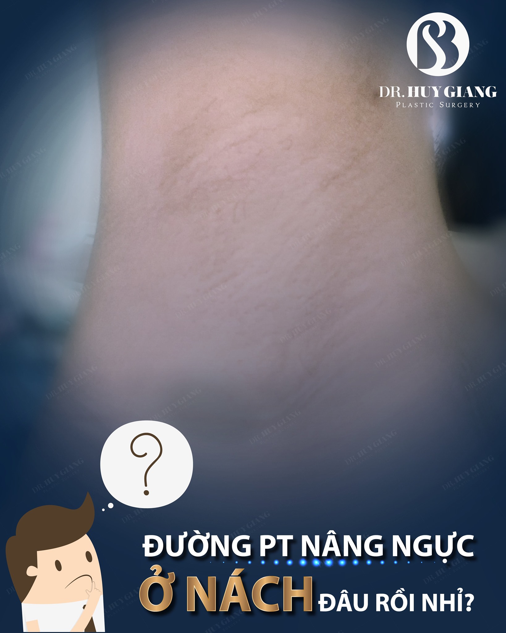 Nâng ngực bằng đường mổ nào nhanh nhất?