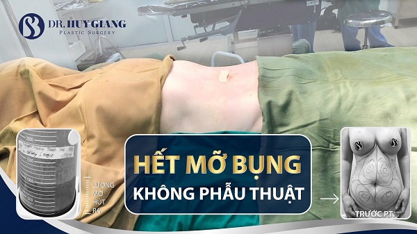 Hút mỡ bụng có bị béo lại không