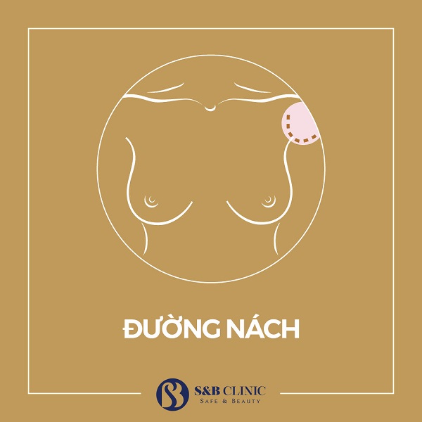 Nâng ngực mổ ở đâu? Đường mổ nào cho kết quả đẹp nhất?