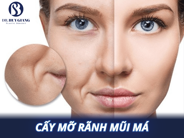 Cấy mỡ rãnh mũi má - Xoá bỏ già nua, hốc hác