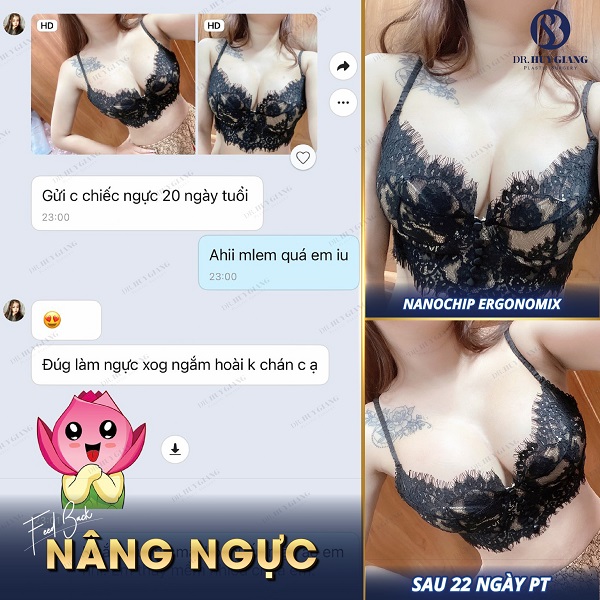 Kết quả nâng vòng 1 ngay sau phẫu thuật