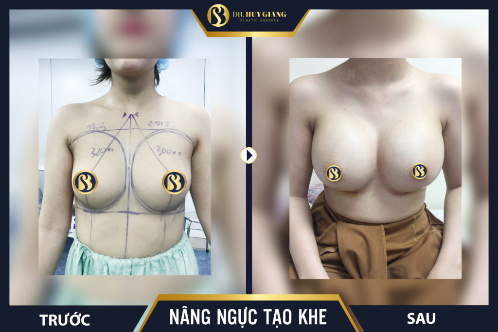 Tình trạng ngực trước nâng ngực nội soi đa chiều: ngực nhỏ, cực trên teo lép, đầu ngực chếch sang 2 bên