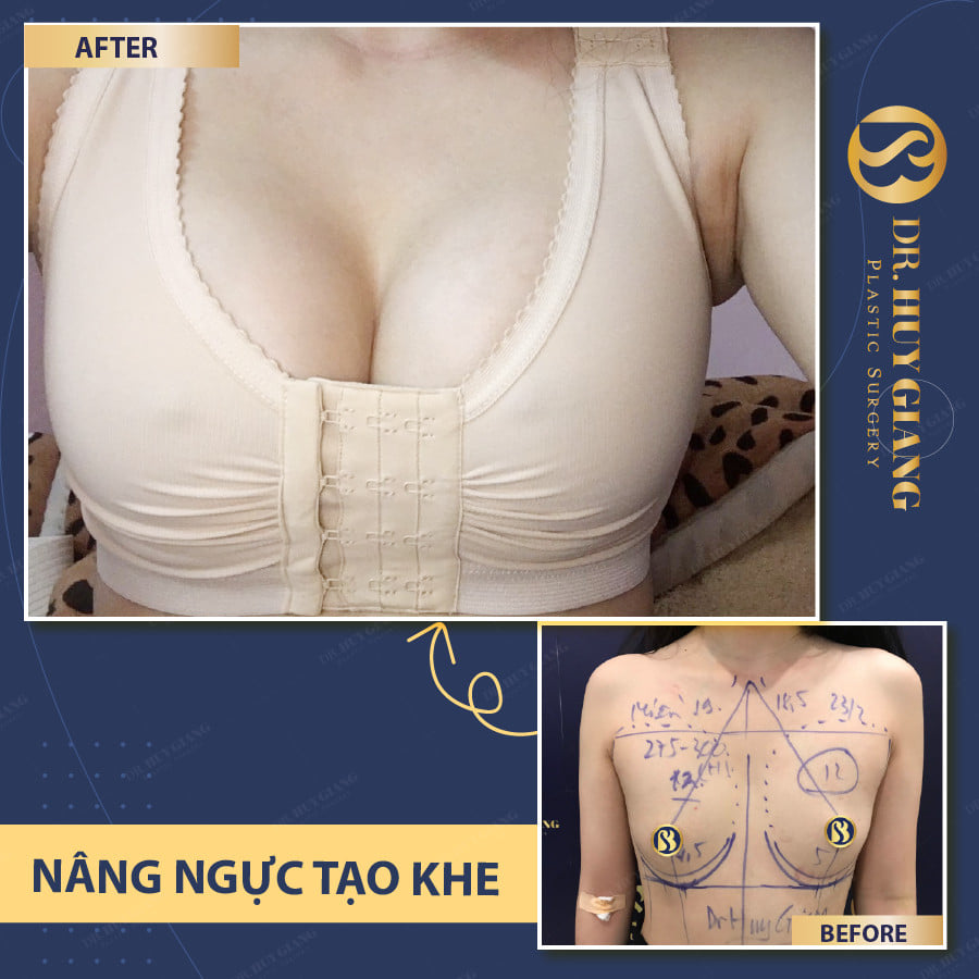 Khách nâng vòng 1 tại Dr Huy Giang