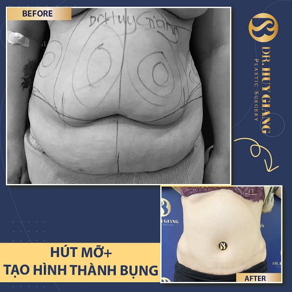 Hút mỡ tạo hình thành bụng tại Dr Huy Giang
