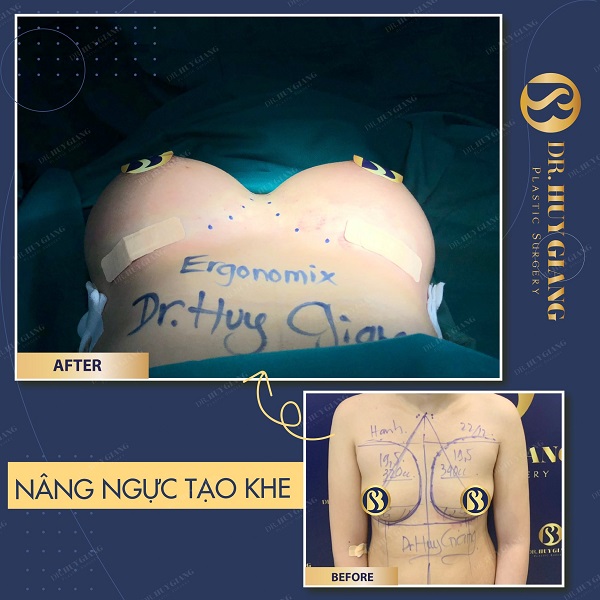 Nâng ngực giúp vòng 1 căng tròn cân đối tại Dr Huy Giang