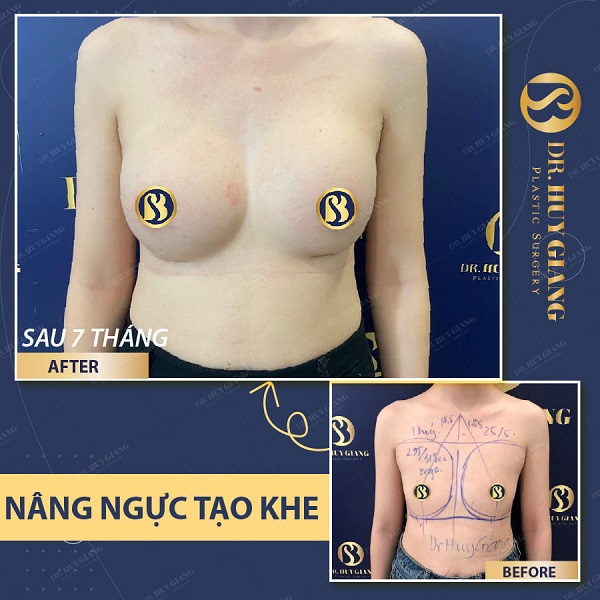 Khách hàng trước và sau nâng ngực tạo khe tại Dr Huy Giang