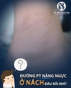 Cách hạn chế sẹo sau nâng ngực