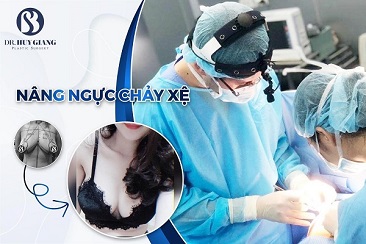 Nâng ngực chảy xệ giá bao nhiêu khi đặt túi và không đặt túi?