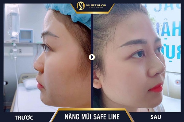 Ảnh khách hàng trước và sau nâng mũi tại Dr Huy Giang