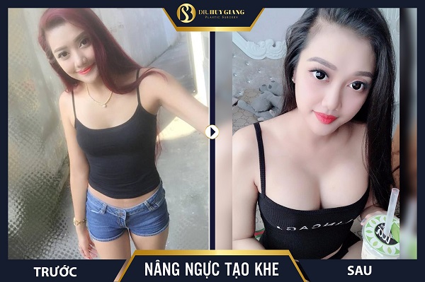 Hình ảnh khách hàng sau nâng ngực tại Dr Huy Giang