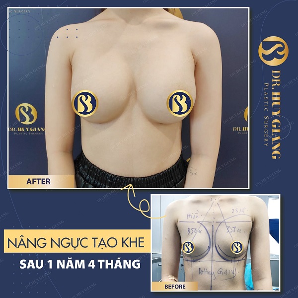 Khách hàng trước - sau nâng ngực nội soi tại Dr Huy Giang 