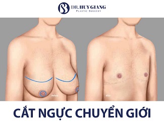 Phẫu thuật cắt ngực chuyển giới an toàn nhất tại Việt Nam