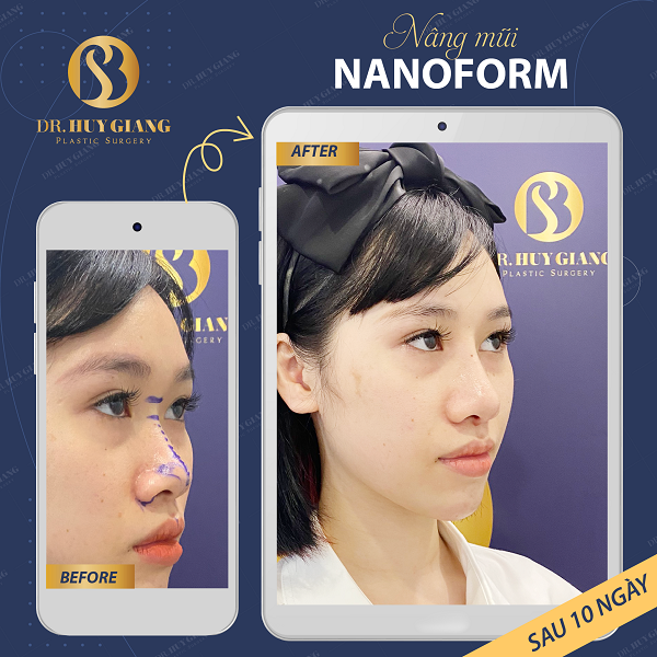 Nâng mũi NanoForm - Công nghệ, chất liệu độc quyền