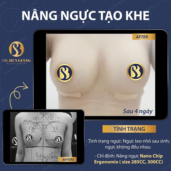 Kết quả nâng ngực tại Dr Huy Giang