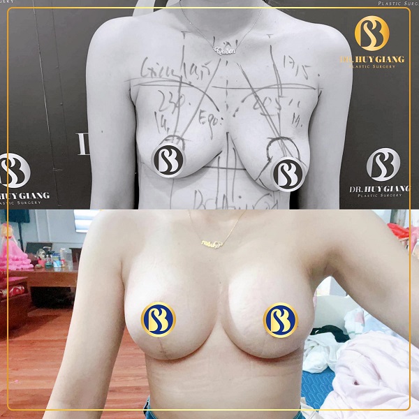 Kết quả nâng ngực chảy xệ độ 1 bên phải, độ 3 bên trái
