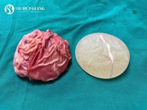 Bóc tách bao xơ, thay túi ngực