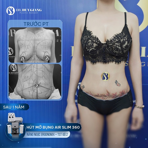 Combo nâng ngực hút mỡ