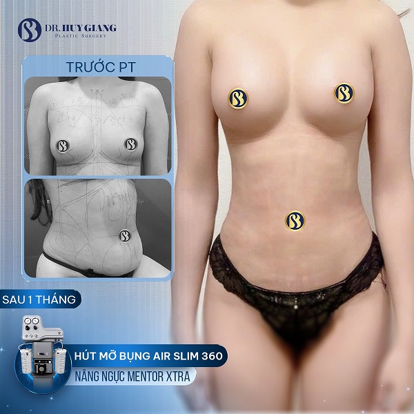 Combo nâng ngực hút mỡ