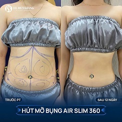Hút mỡ siết eo - Đánh bay mỡ thừa sau 90'