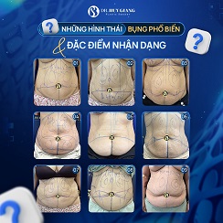 Siết eo sau sinh: Sồ sề thon gọn tức thì