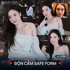 Độn cằm bằng chất liệu gì? Có vĩnh viễn không?