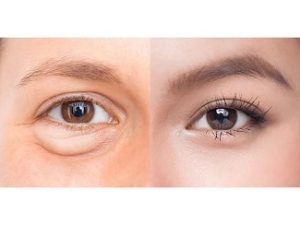Lấy Mỡ Bọng Mắt – Giải Pháp Trẻ Hóa Đôi Mắt An Toàn