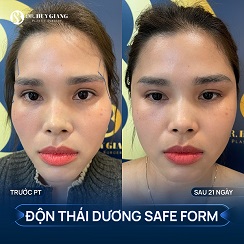 Độn thái dương có vĩnh viễn không?