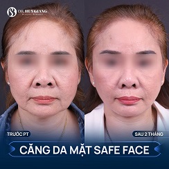 Căng da mặt giữ được bao lâu? Có vĩnh viễn không?