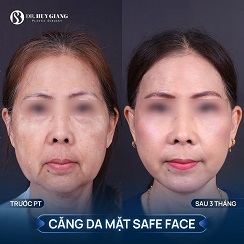 Căng da mặt bao nhiêu tiền? Giá mới nhất 2025