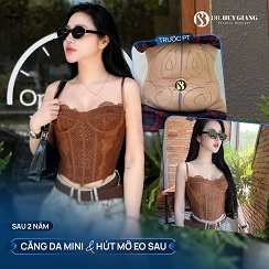 Căng da bụng mini - Eo thon gọn tức thì