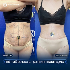 Cắt da thừa bụng - Bụng phẳng da căng nhanh nhất