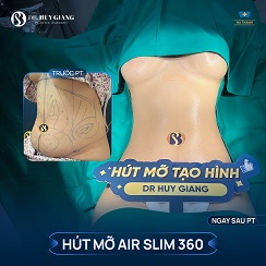 Tạo hình thành bụng mini - Sẹo ngắn như mổ đẻ